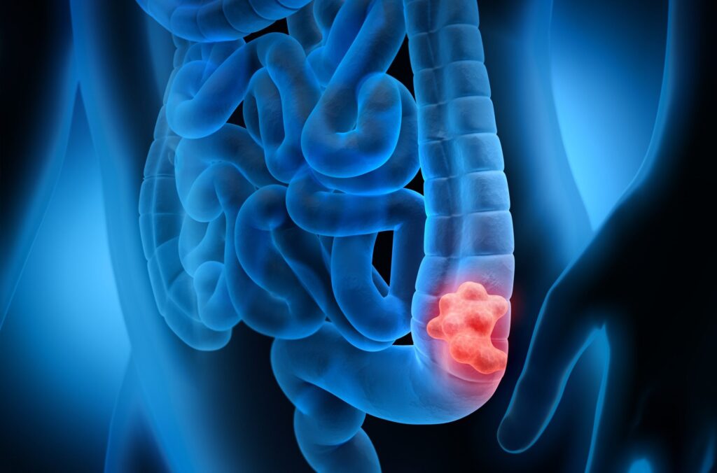 The Untold Story of the Colorectal Cancer Drug Trial!